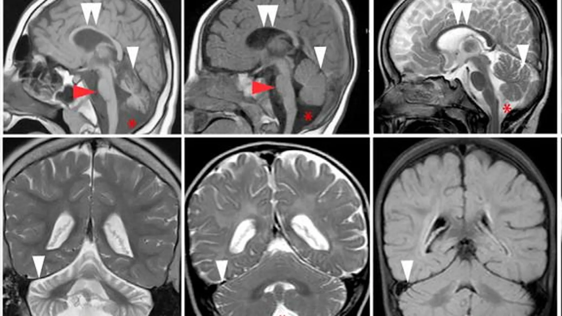 La extraña malformación neuronal heredada del Imperio otomano