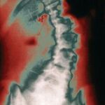 Radiografía de una columna vertebral con escoliosis