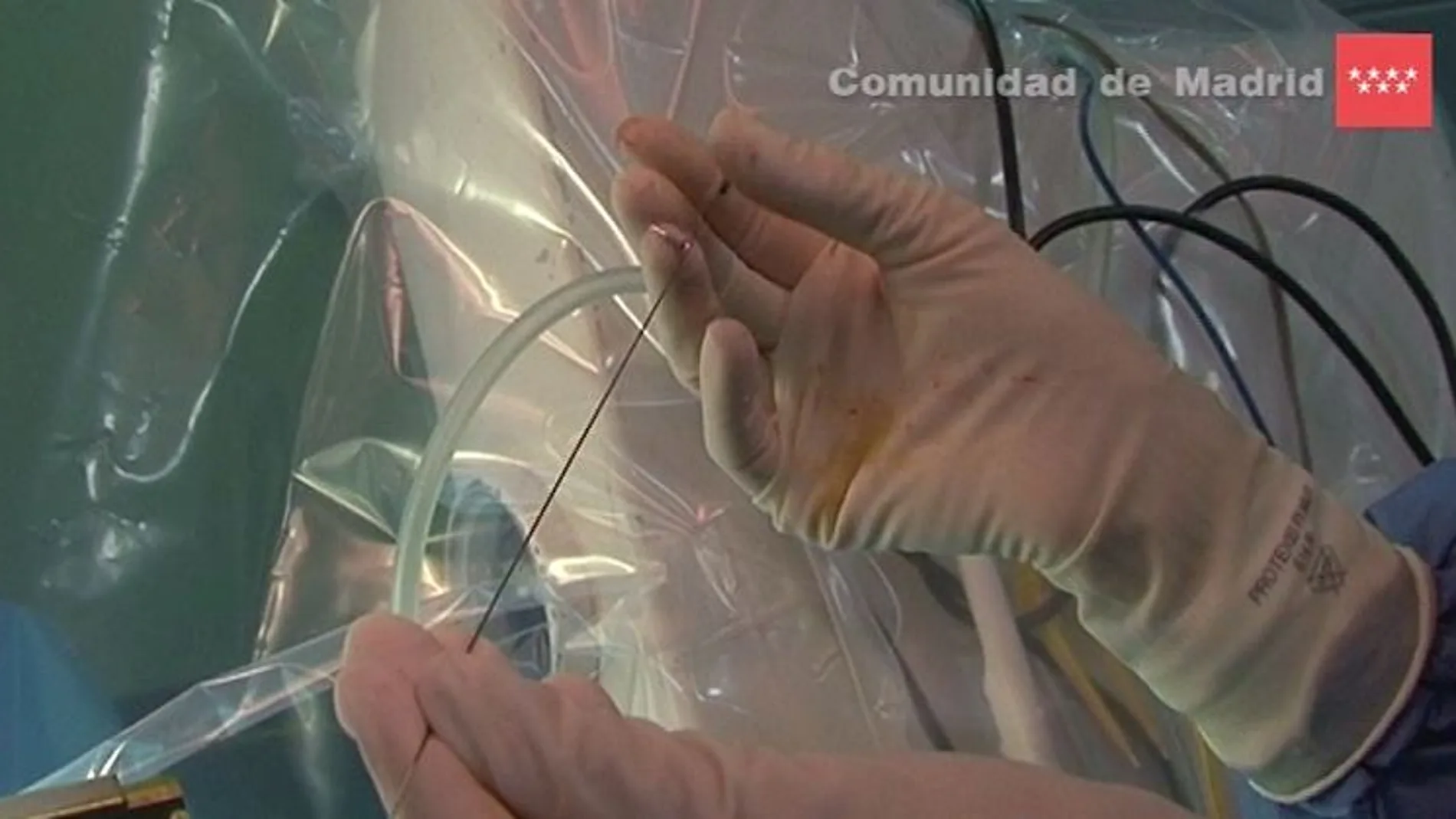 Madrid trata el Parkinson con implantes de electrodos en el cerebro que controlan los movimientos