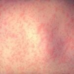 El sarampión es una enfermedad viral altamente contagiosa, que afecta sobre todo a los niños