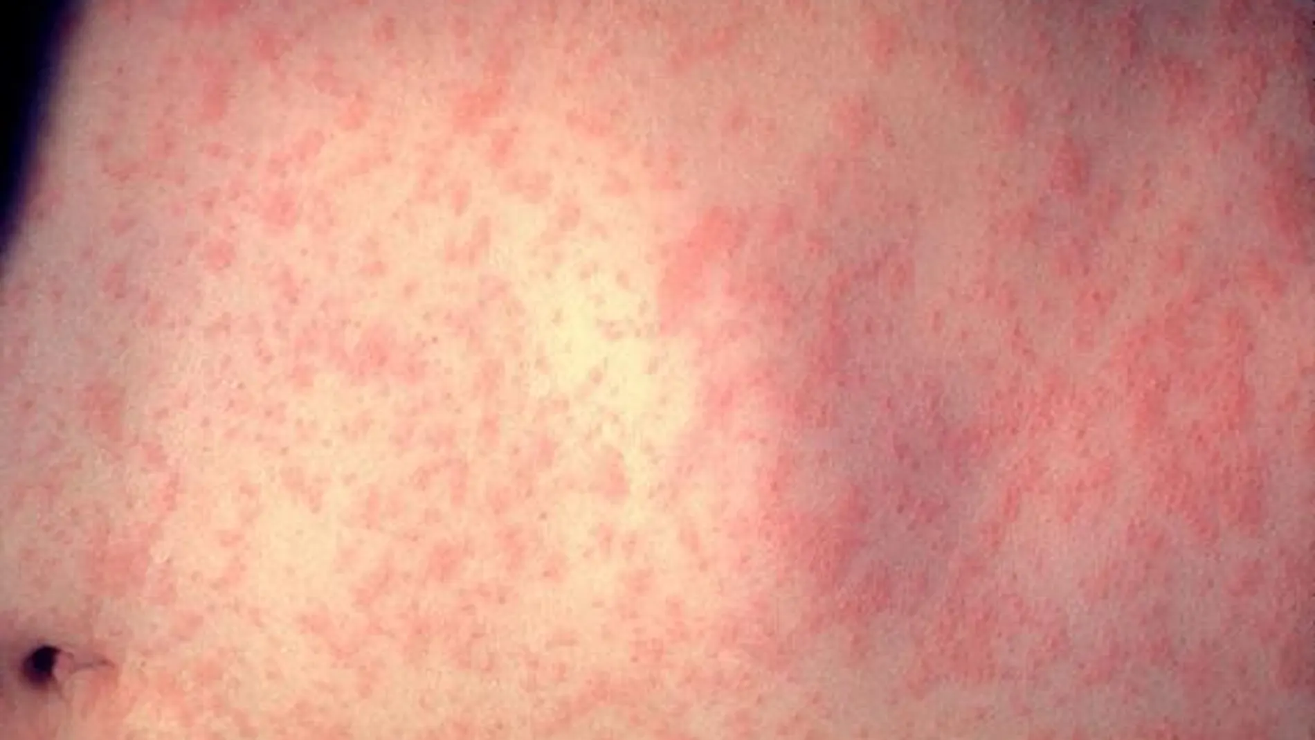 El sarampión es una enfermedad viral altamente contagiosa, que afecta sobre todo a los niños