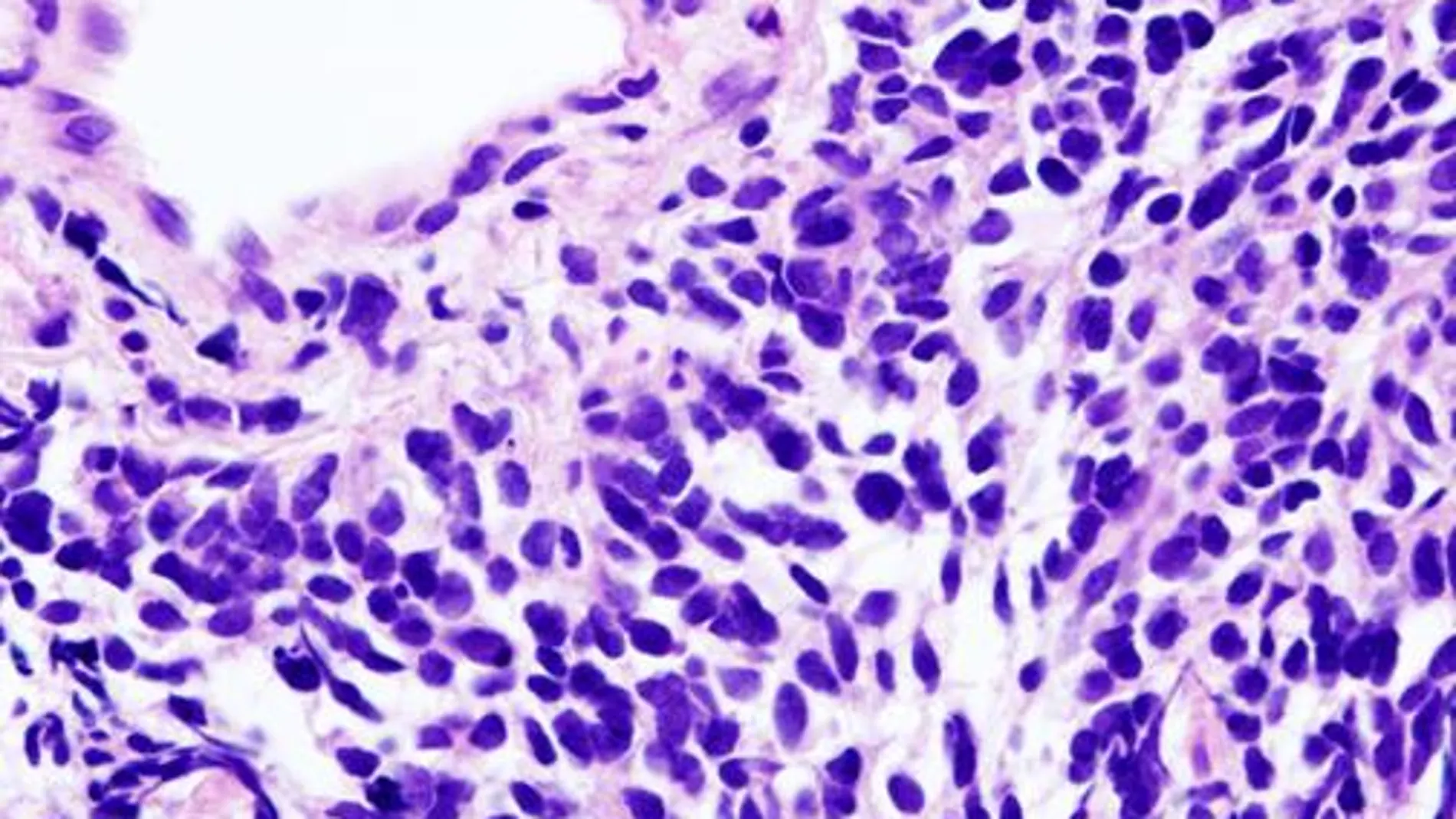 Vista microscópica de una biopsia de carcinoma de pulmón de células pequeñas