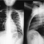 Se utilizarán las radiografías torácicas de los pacientes
