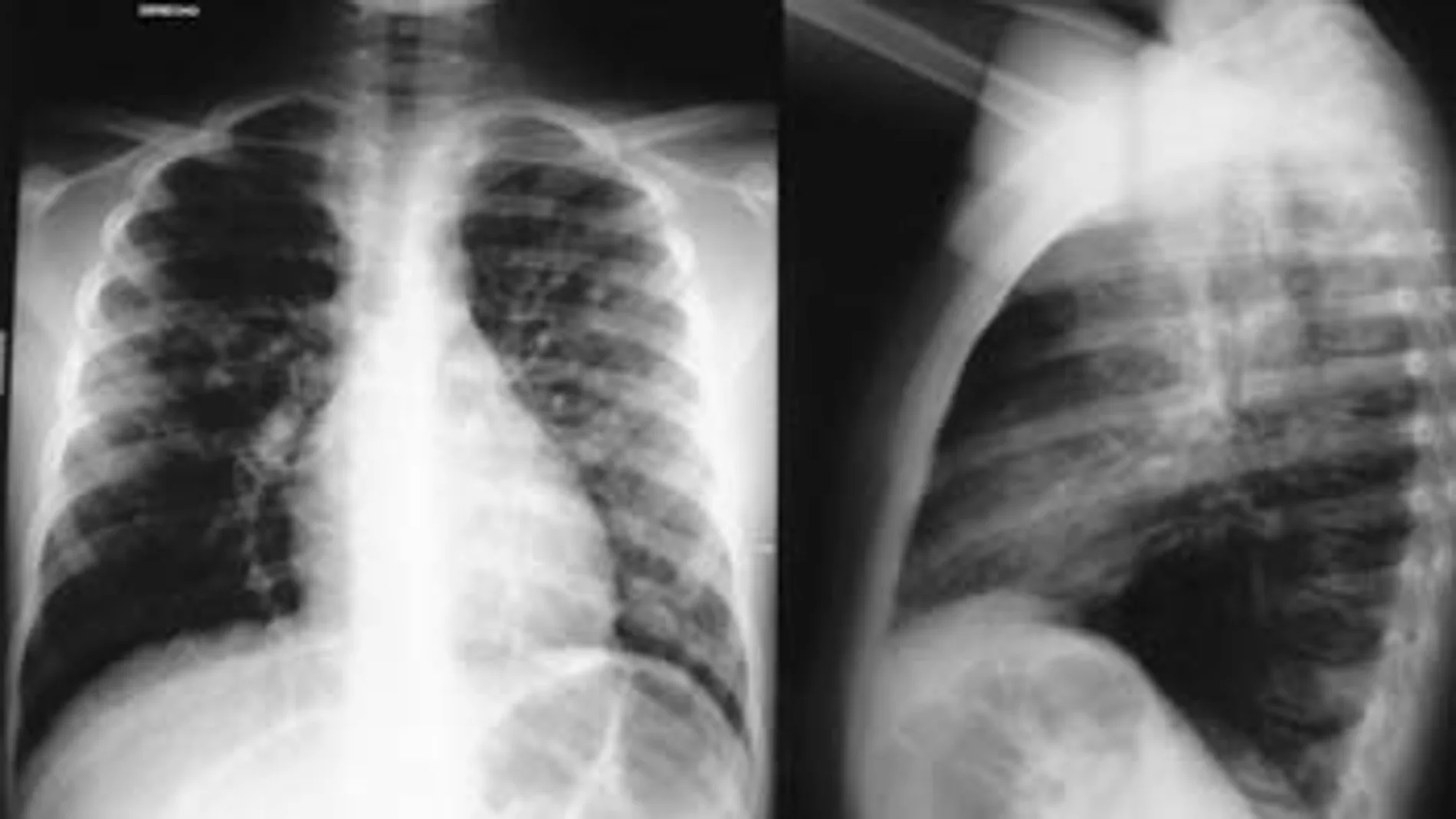 Se utilizarán las radiografías torácicas de los pacientes