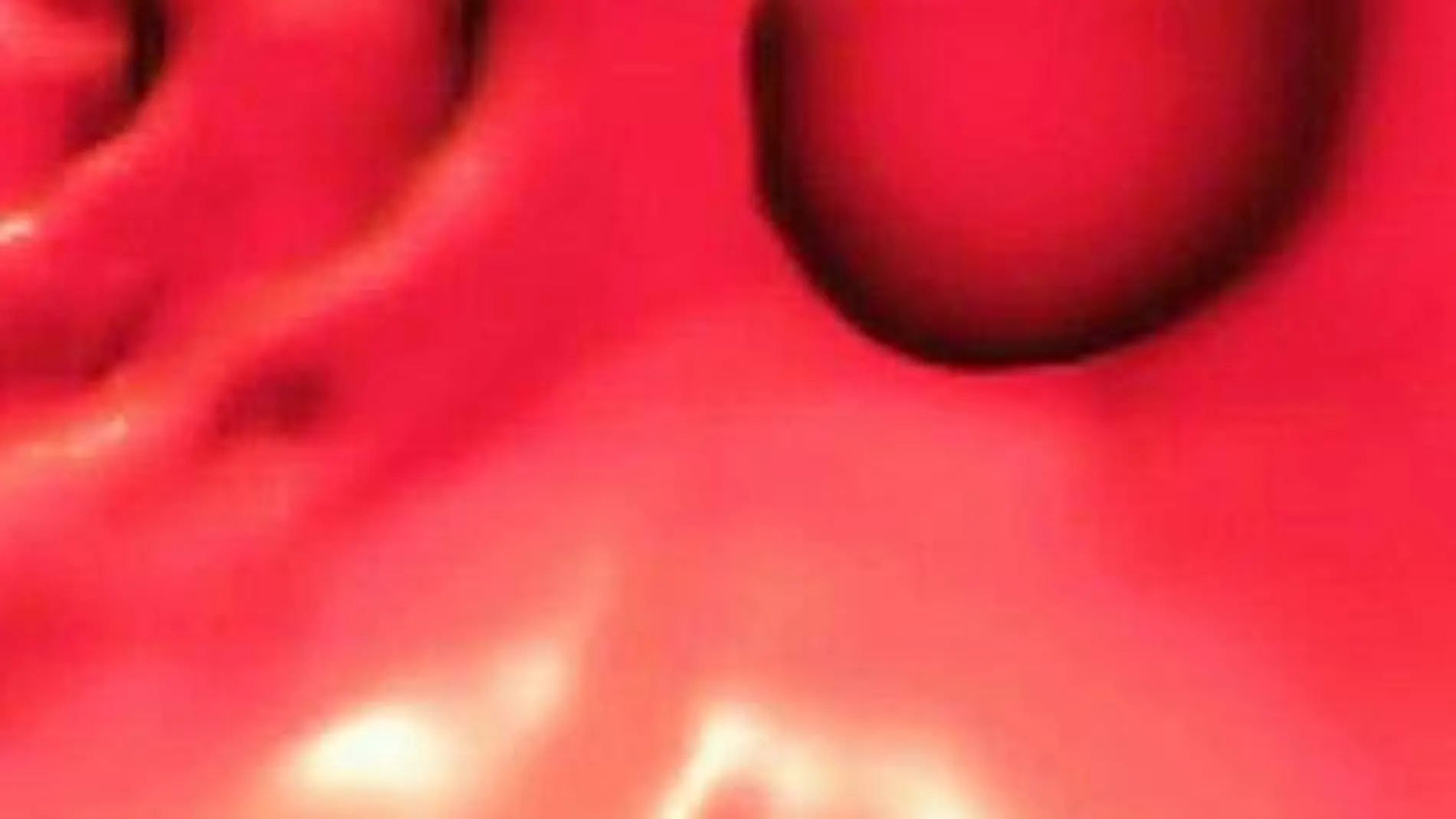 La cirugía es la mejor opción contra el cáncer de colon inicial