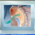 Cirujanos del hospital Clínic de Barcelona han extirpado por primera vez en Europa un tumor gástrico de 8 centímetros de diámetro a través de la vagina