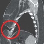 Radiografía de la paciente tres semanas después de tomar el cóctel de fármacos