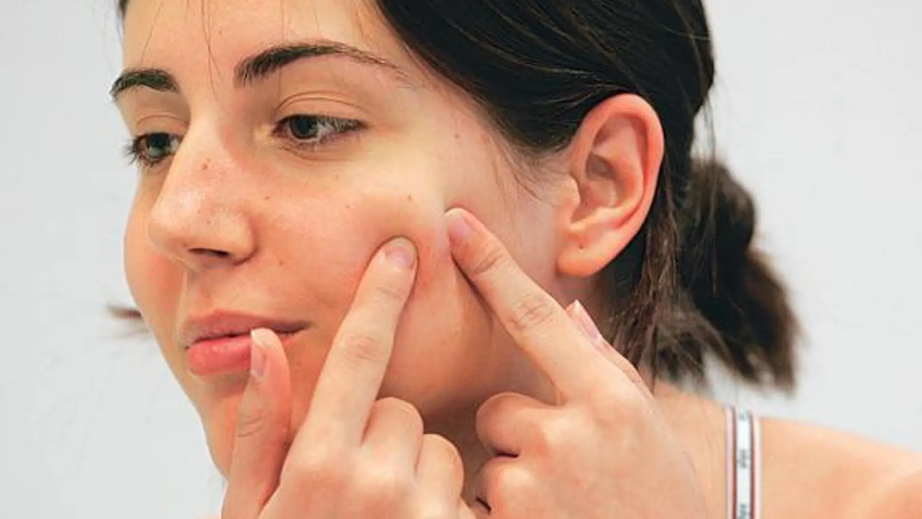 Hacer frente a los casos graves de acné en la botica