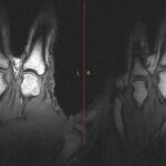 Imagen de la resonancia magnética, en la que se observa que el hueco entre la articulación y el hueso de la mano es mayor en la parte izquierda que en la derecha, como consecuencia del chasquido