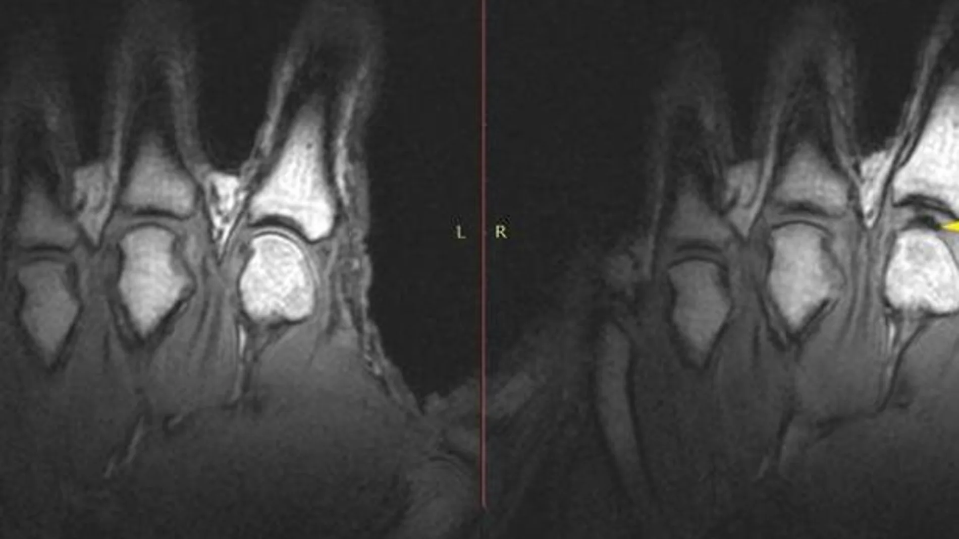 Imagen de la resonancia magnética, en la que se observa que el hueco entre la articulación y el hueso de la mano es mayor en la parte izquierda que en la derecha, como consecuencia del chasquido