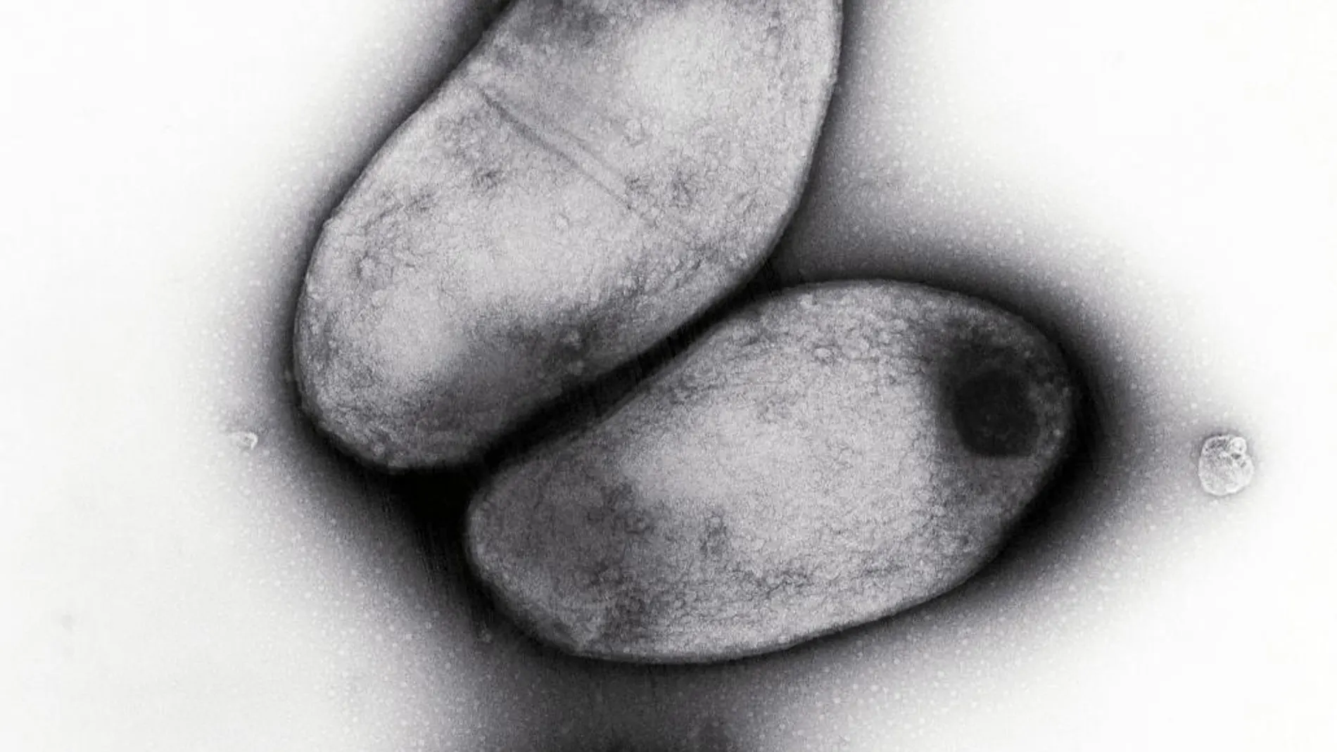 Difteria