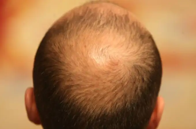 Salvados por los pelos tras la alopecia
