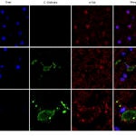 Análisis de inmunohistoquímica de secciones cerebrales de la corteza frontal de una persona control y de un paciente diagnosticado de ELA (ALS11). El núcleo de las células se tiñó con DAPI (azul), mientras que las células de hongo se detectaron con un anticuerpo específico (verde) y la tubulina celular se muestra en rojo