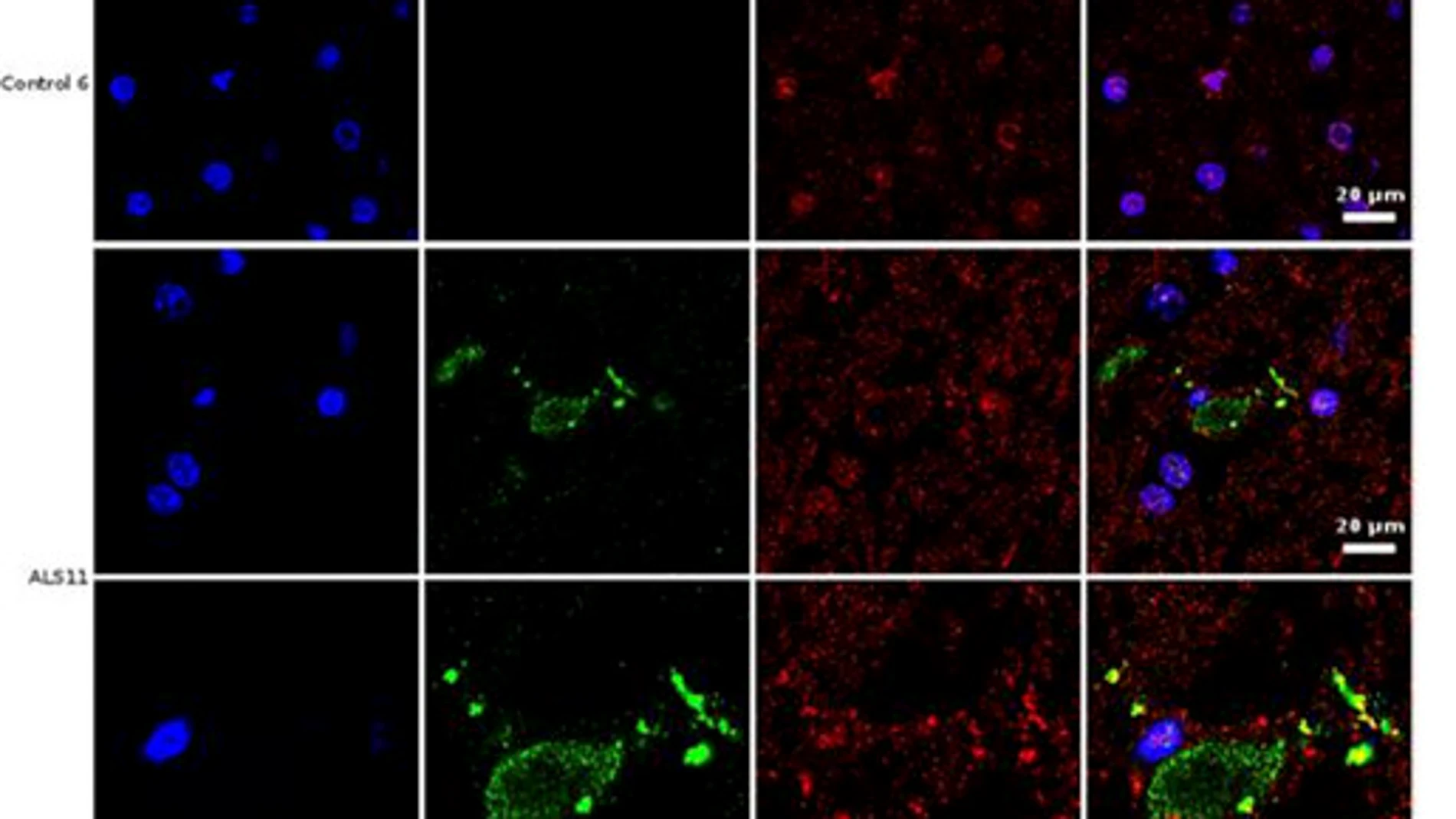 Análisis de inmunohistoquímica de secciones cerebrales de la corteza frontal de una persona control y de un paciente diagnosticado de ELA (ALS11). El núcleo de las células se tiñó con DAPI (azul), mientras que las células de hongo se detectaron con un anticuerpo específico (verde) y la tubulina celular se muestra en rojo