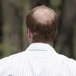 Casi el 50 % de la población española padece alopecia