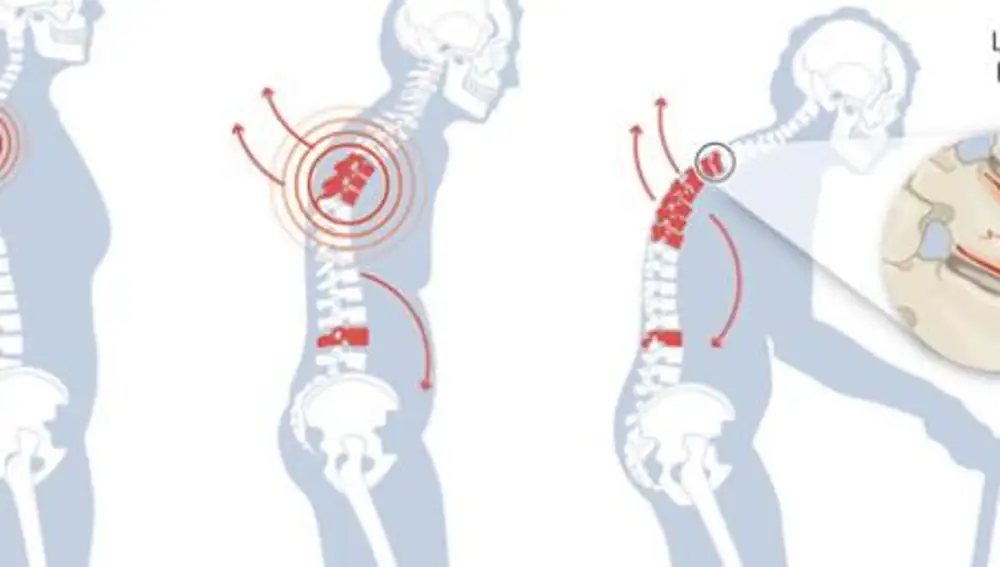 Osteoporosis: casi un millón de hombres sufren esta debilidad ósea