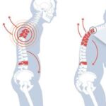 Osteoporosis: casi un millón de hombres sufren esta debilidad ósea