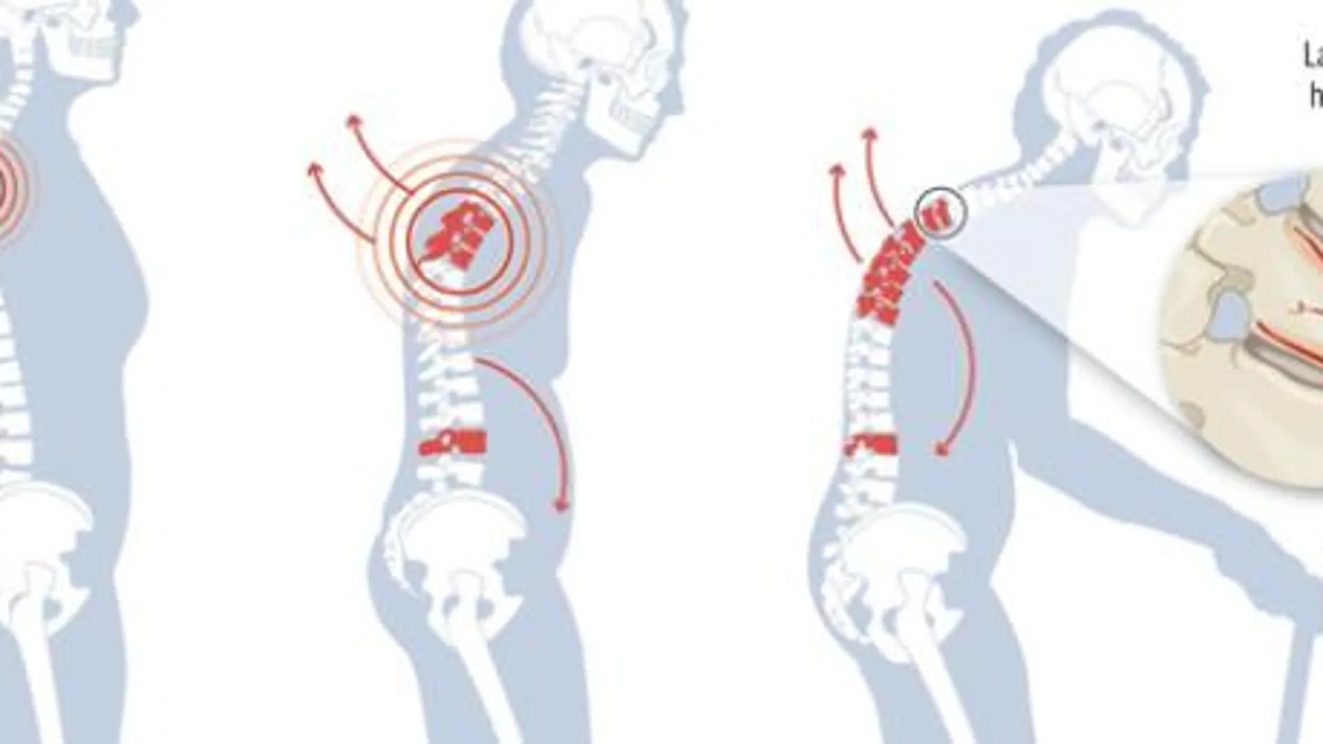Osteoporosis: casi un millón de hombres sufren esta debilidad ósea