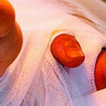 Salvan la mano de una niña cosiéndosela a la pierna