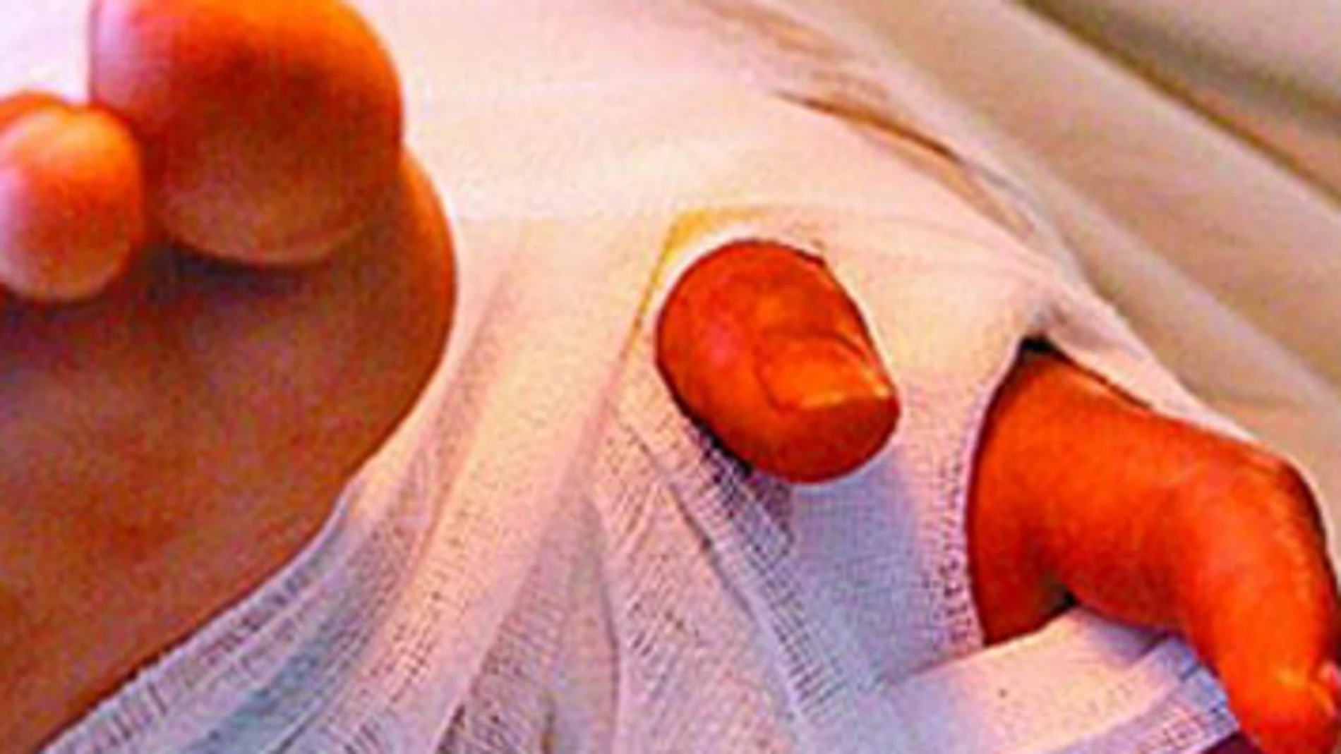 Salvan la mano de una niña cosiéndosela a la pierna