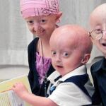Imágenes de pacientes que sufren progeria, la enfermedad por la cual envejecen mucho más rápidamente de lo normal