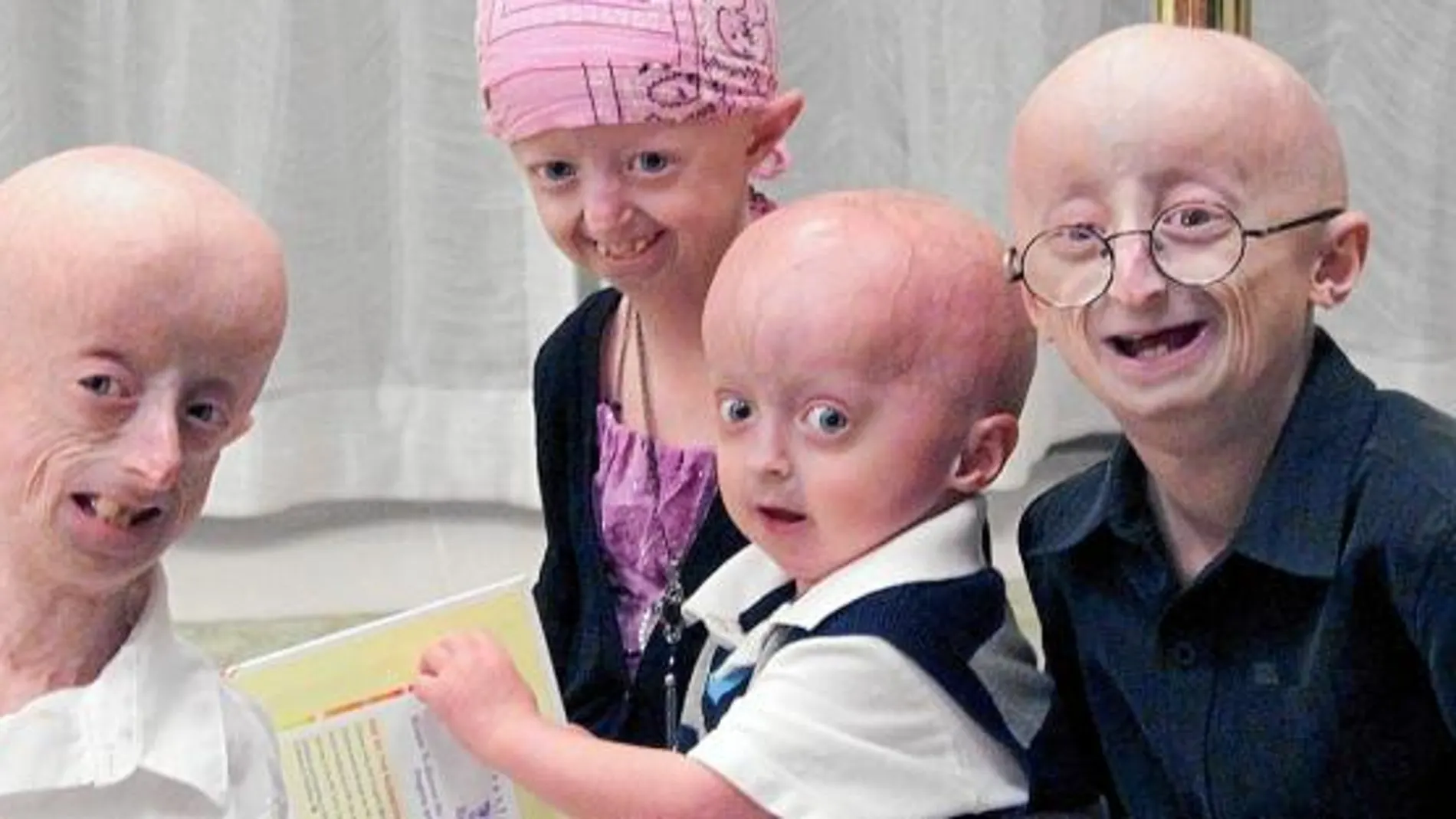Imágenes de pacientes que sufren progeria, la enfermedad por la cual envejecen mucho más rápidamente de lo normal