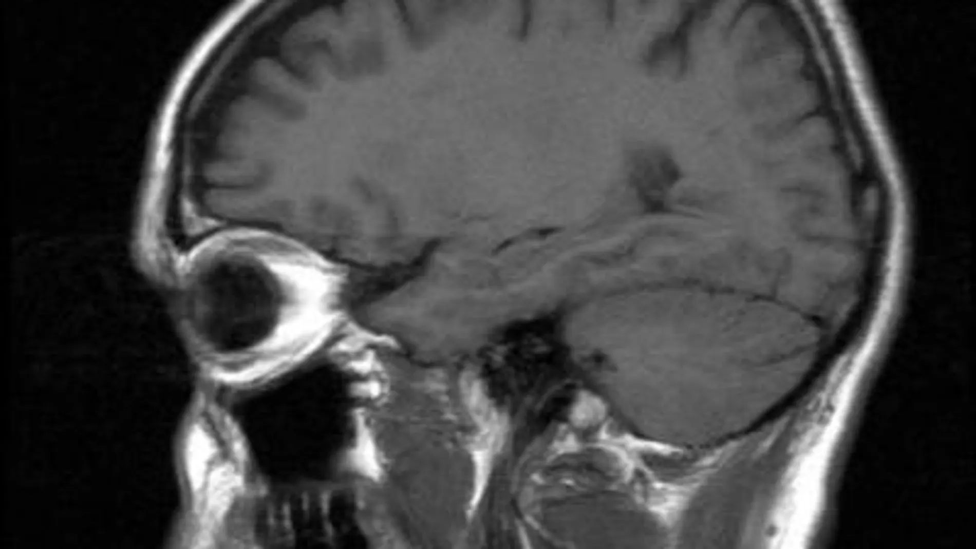 Combinar terapias contra el tumor cerebral / SXC