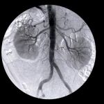 Los niveles elevados de la proteína DKK3 en la orina al inicio de seguimiento se asociaron con mayor progresión del daño renal en los años siguientes