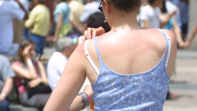 Protección solar, lo mejor para evitar la aparición de melanomas