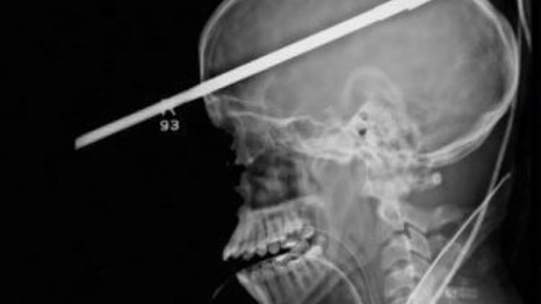 Sobrevive de milagro a un arpón que le atravesó el cerebro