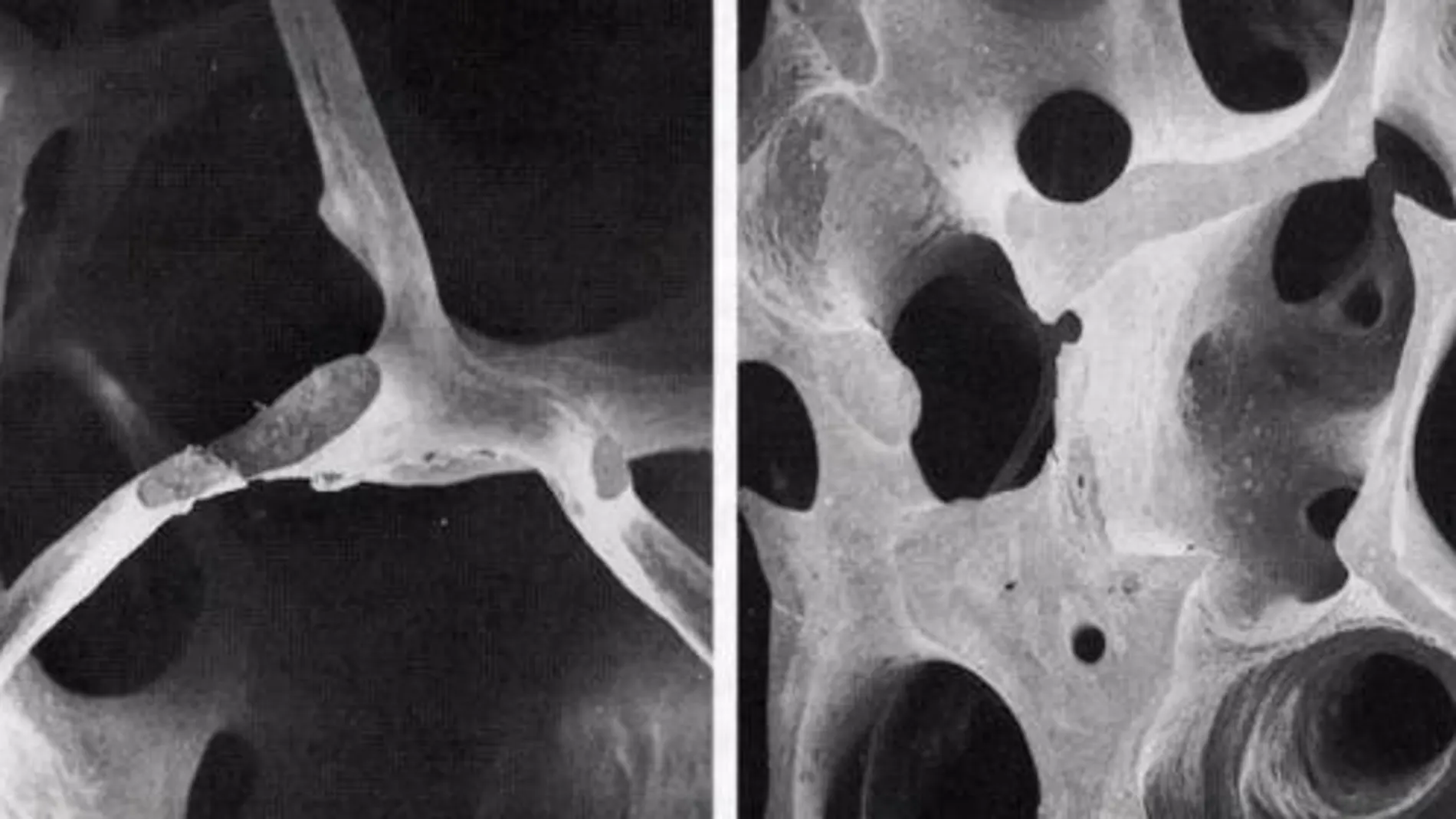 A la izquierda, un hueso con osteoporosis; a la derecha, un hueso sano