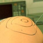 Grasa de liposución como biocombustible
