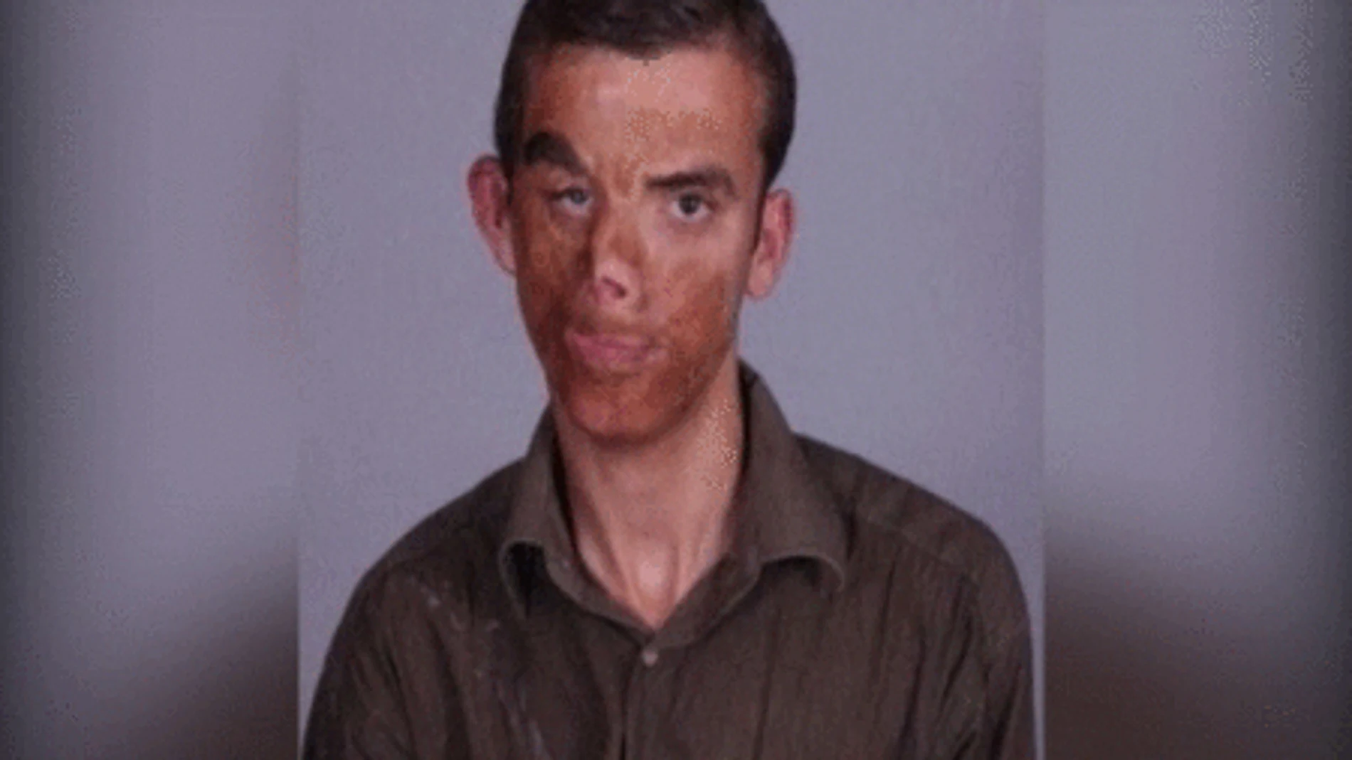 Trasplantan las dos manos una pierna y el rostro de un donante a dos receptores
