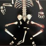 Imagen del Departamento de Salud de Moscú de la radiografía del bebe con tres piernas