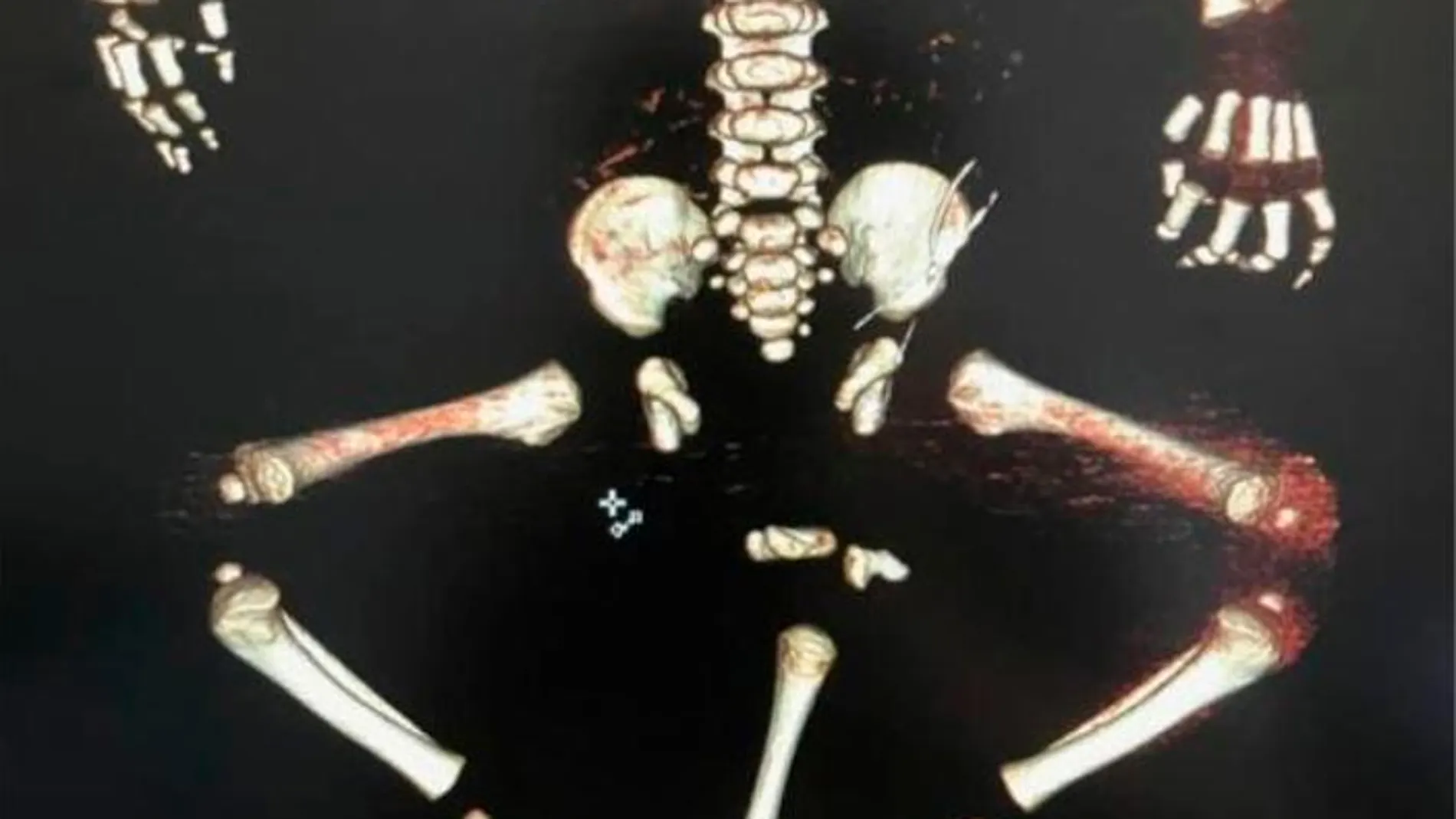 Imagen del Departamento de Salud de Moscú de la radiografía del bebe con tres piernas