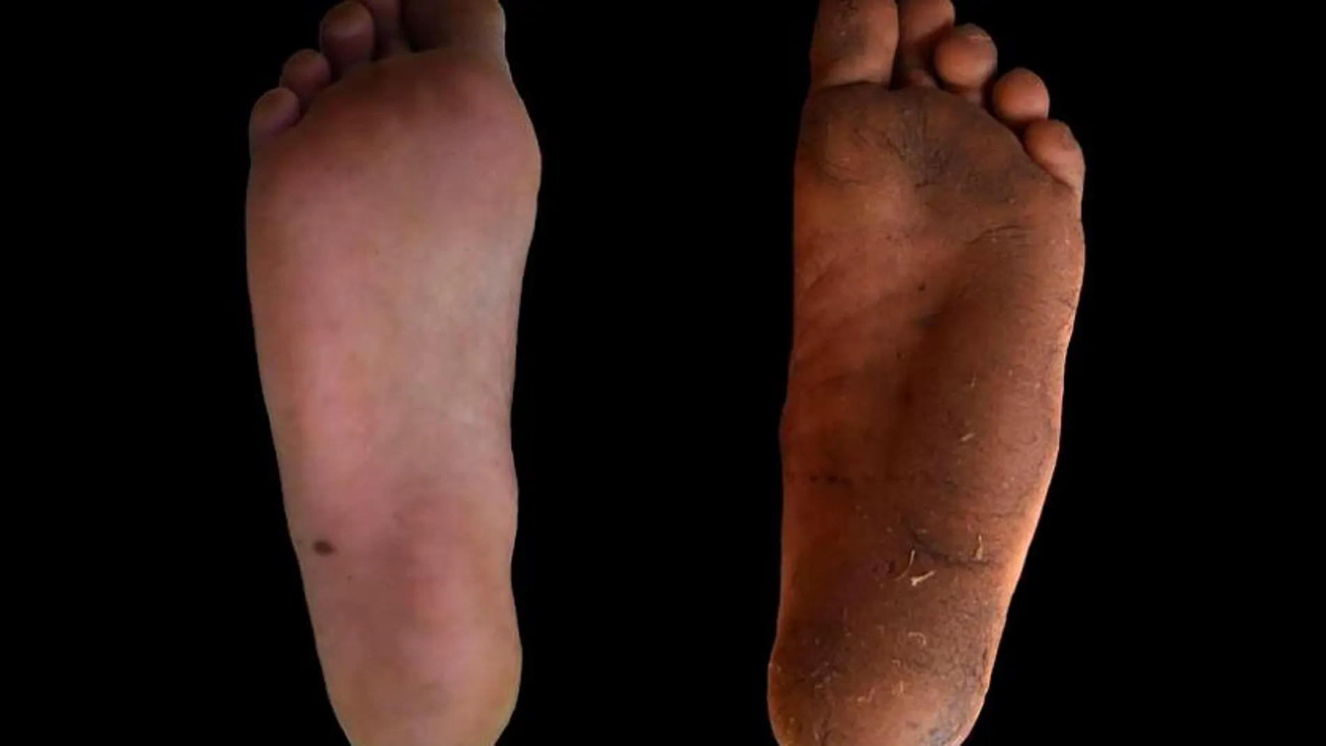 Diferencia entre uno de los pies de un participante en el estudio que habitualmente va calzado y otro que suele ir descalzo /Foto: DANIEL LIEBERMAN
