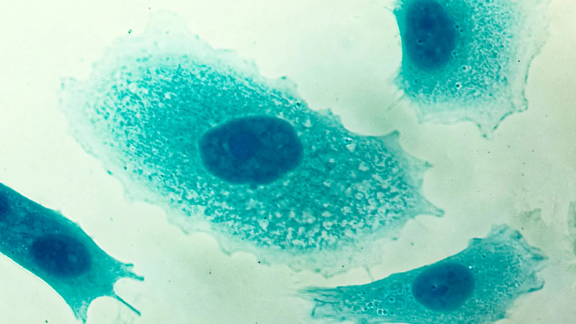Células cancerígenas en la próstata