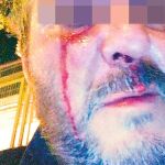 Vigilante con hematomas y cortes agredido el pasado jueves en Vallecas
