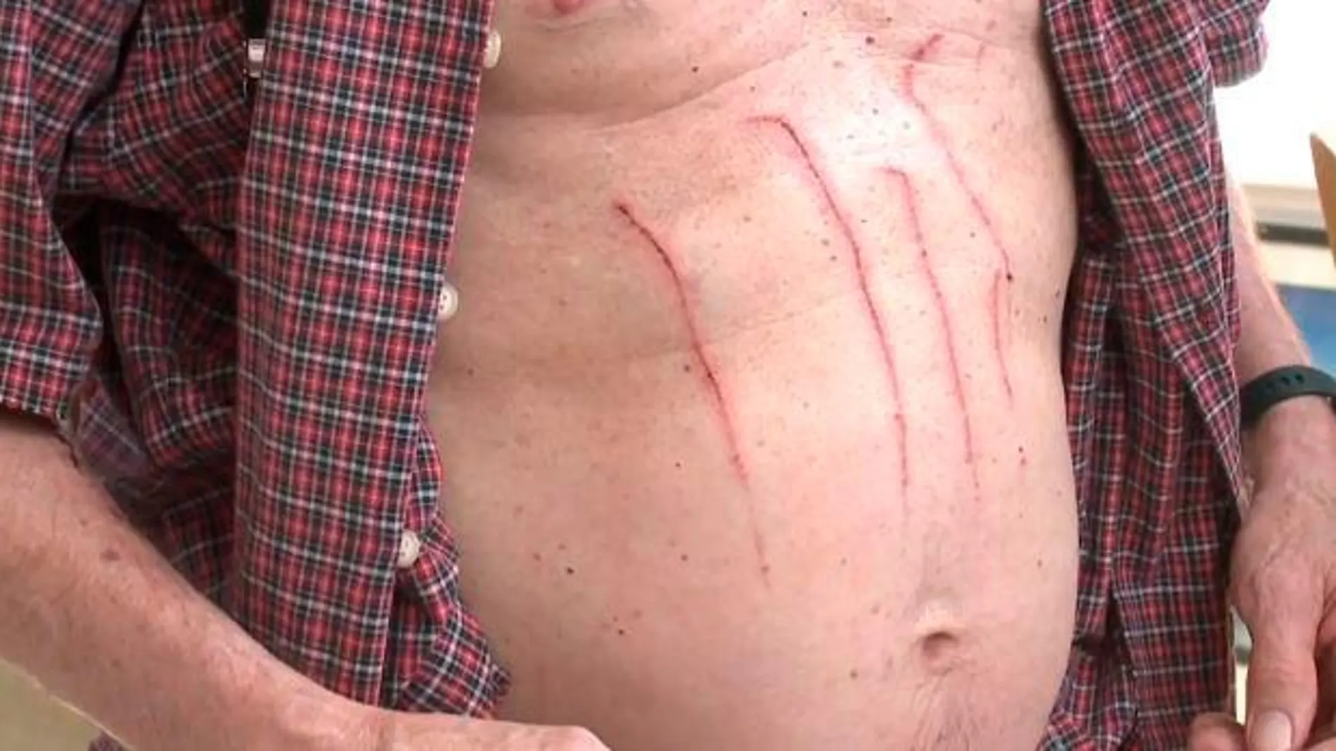 Imagen de pecho de Jon Johnson, con la marca de las garras del oso, que también lo alcanzó en el brazo y la nariz