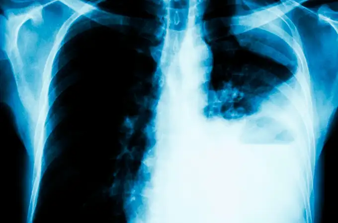 Solo el 40% de los pacientes con fibrosis pulmonar idiopática sobrevive a los cinco años