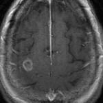 Resonancia magnética de un cerebro afectado por la ameba ‘comecerebros’