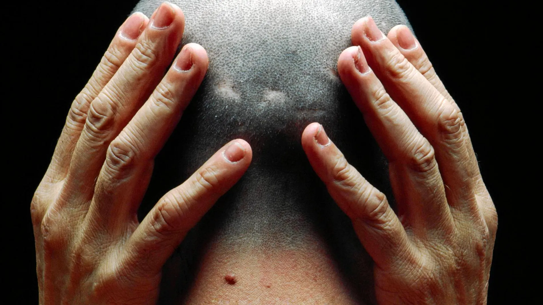 Hay más de 100 causas a la pérdida de cabello. Foto: Alberto Schommer/Vegap