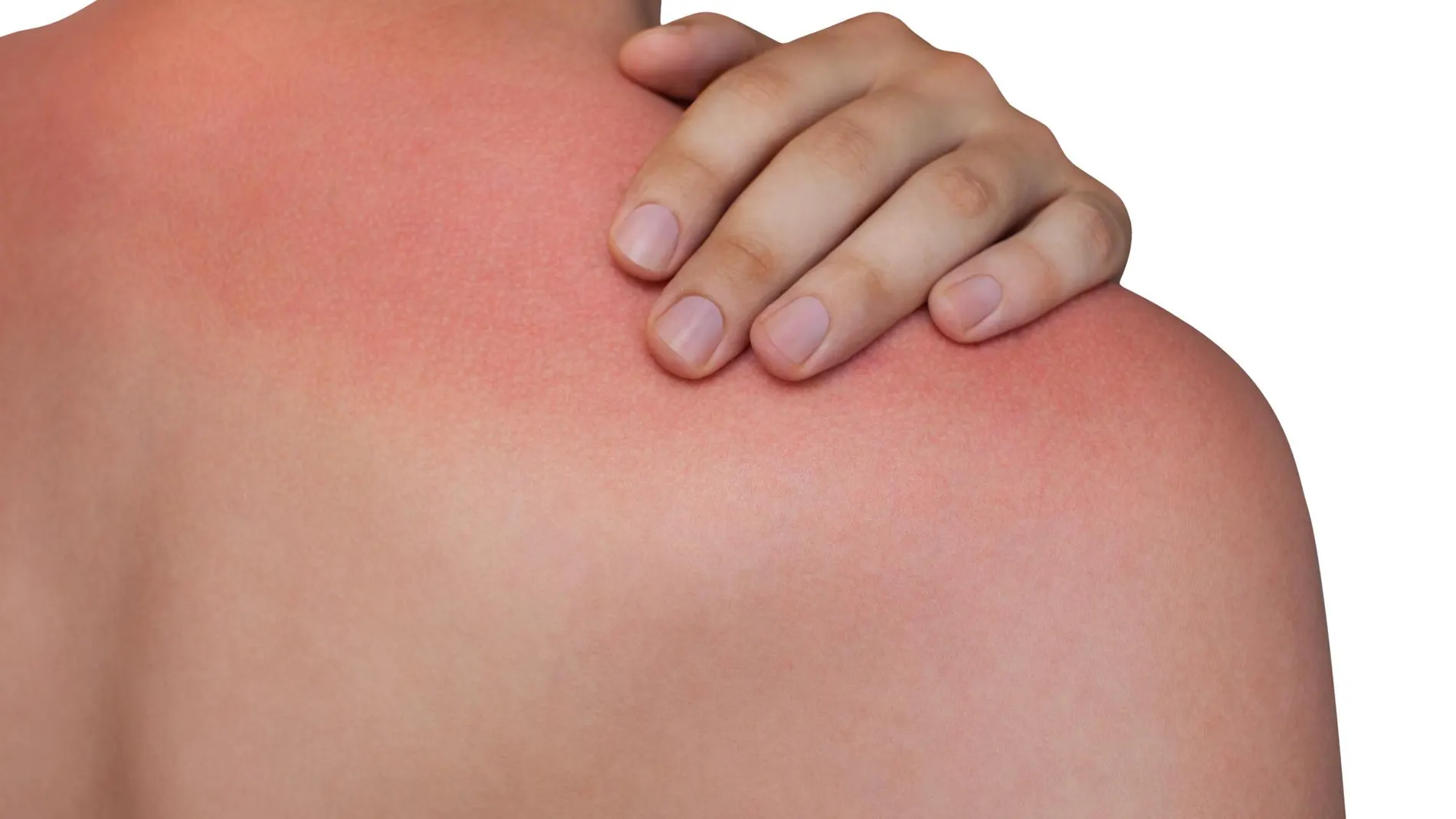 ¿Alergia al sol? Conoce las posibles causas para lograr un tratamiento adecuado