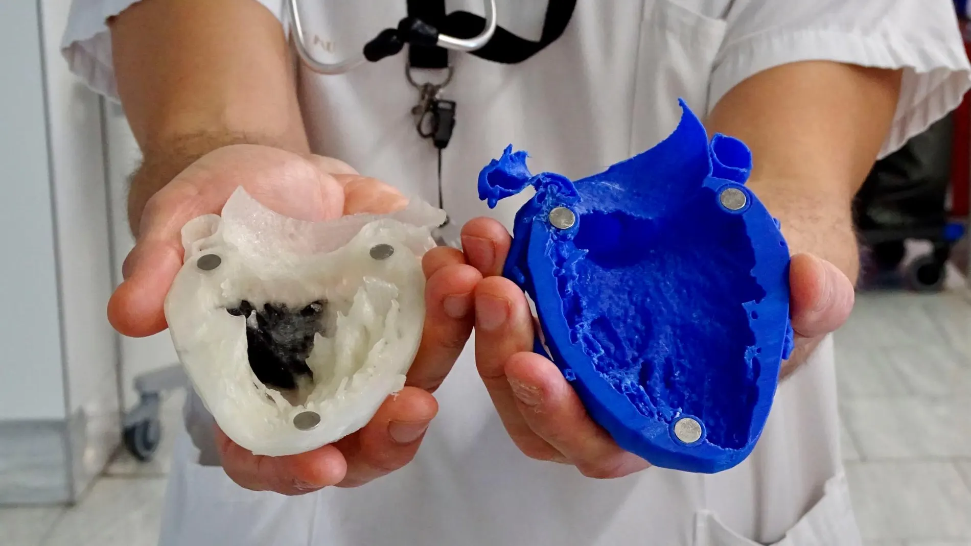 El paciente muestra una réplica de su corazón que ha servido al equipo médico para poder intervenirlo