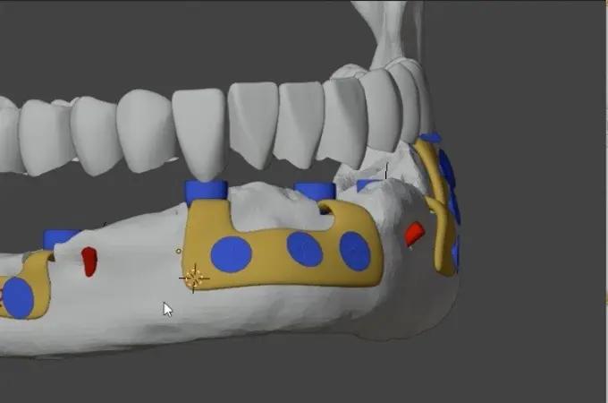 Colocan la primera prótesis 3D maxilofacial en España