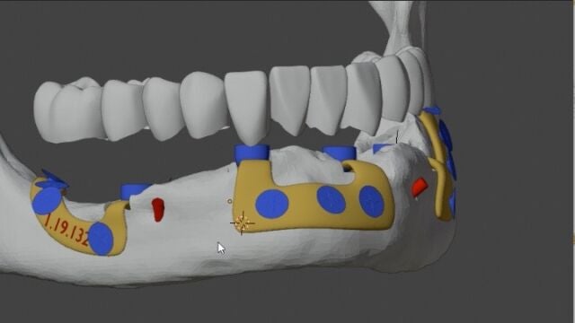 Primera prótesis dental 3D en España
