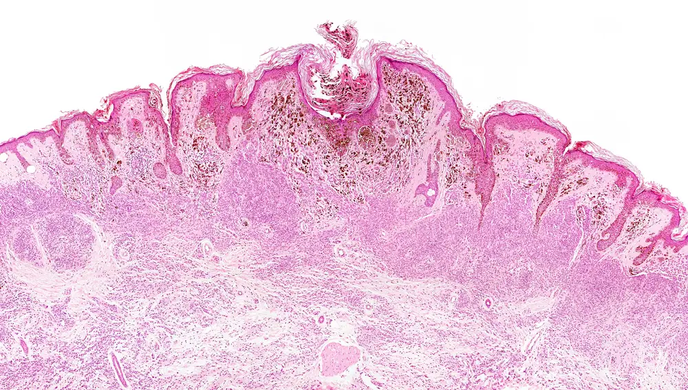 l melanoma puede surgir en las células madre pigmentarias que se originan tanto en los folículos como en las capas de la piel