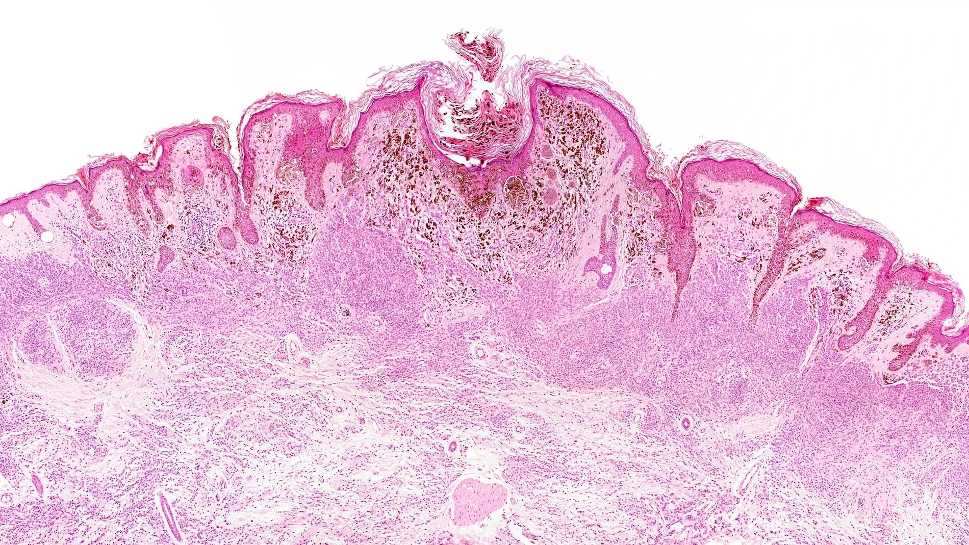 l melanoma puede surgir en las células madre pigmentarias que se originan tanto en los folículos como en las capas de la piel