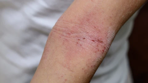 El asma y la dermatitis atópica (DA) afectan a más de 3 y 1,5 millones de personas en España, respectivamente