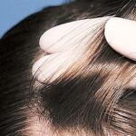 La alopecia traccional puede ser reversible en la mayoría de los casos